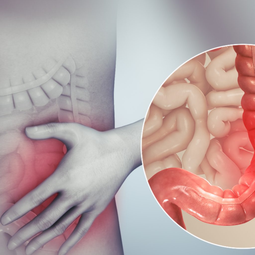 IBD and CancerIBD and Cancer, London Gastroenterology Centre